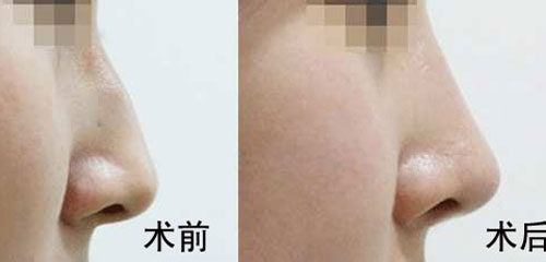 駝峰鼻矯正的方法有哪些？駝峰鼻矯正的方式及適合人群？
