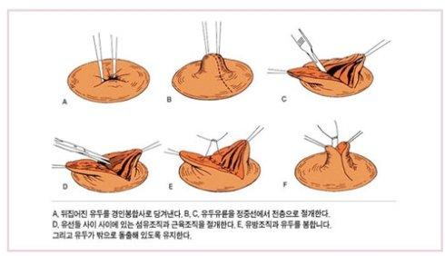 乳頭內(nèi)陷矯正手術(shù)多少錢？乳頭內(nèi)陷矯正手術(shù)多久可以恢復(fù)？