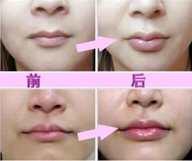 玻尿酸豐唇珠效果怎么樣？玻尿酸豐唇珠多少錢？