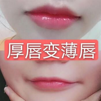 厚唇改薄整形手術(shù)價格？厚唇改薄多久完全恢復(fù)？