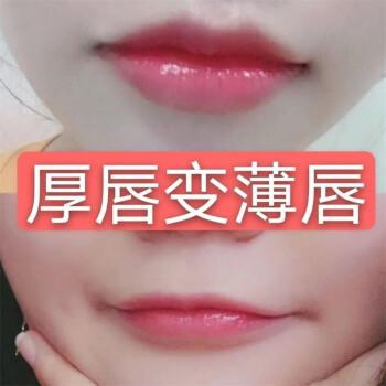 厚唇改薄整形手術(shù)價(jià)格？厚唇改薄多久完全恢復(fù)？