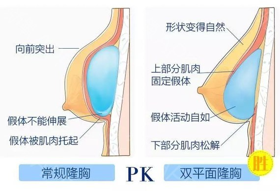 假體隆胸修復怎么做？做隆胸修復能維持多久？