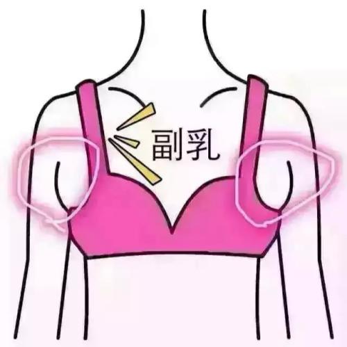 吸脂做副乳要多少錢？吸脂去副乳會反彈嗎？