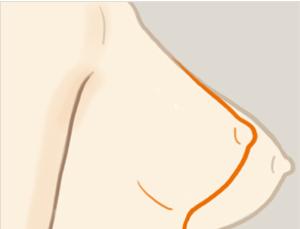 乳房下垂矯正手術(shù)風(fēng)險有多大？ 乳房下垂矯正術(shù)多久能恢復(fù)？