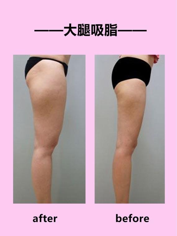 吸脂瘦大腿腫脹期是多久？大腿吸脂有什么后遺癥嗎？