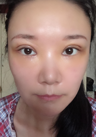  寧波尚美整形美容醫(yī)院做雙眼皮手術后的頭幾天