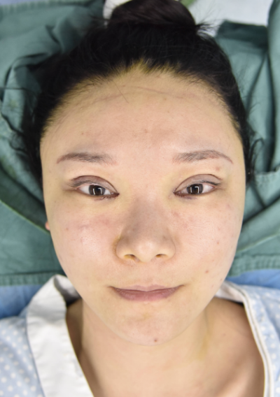  寧波尚美整形美容醫(yī)院做雙眼皮手術剛做完后