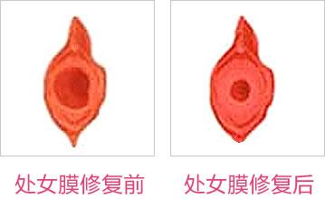 成都東方整形處女膜修復怎么樣？處女膜修復術后如何護理？