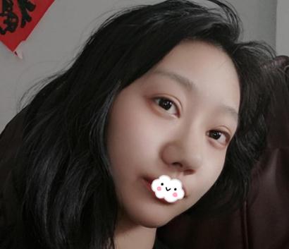 在上海伊美爾港華做假體隆鼻術前效果
