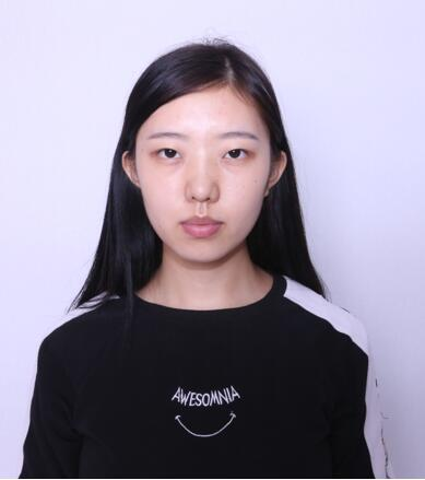 做雙眼皮案例，第四軍醫(yī)大學(xué)唐都醫(yī)院李望舟雙眼皮案例圖片