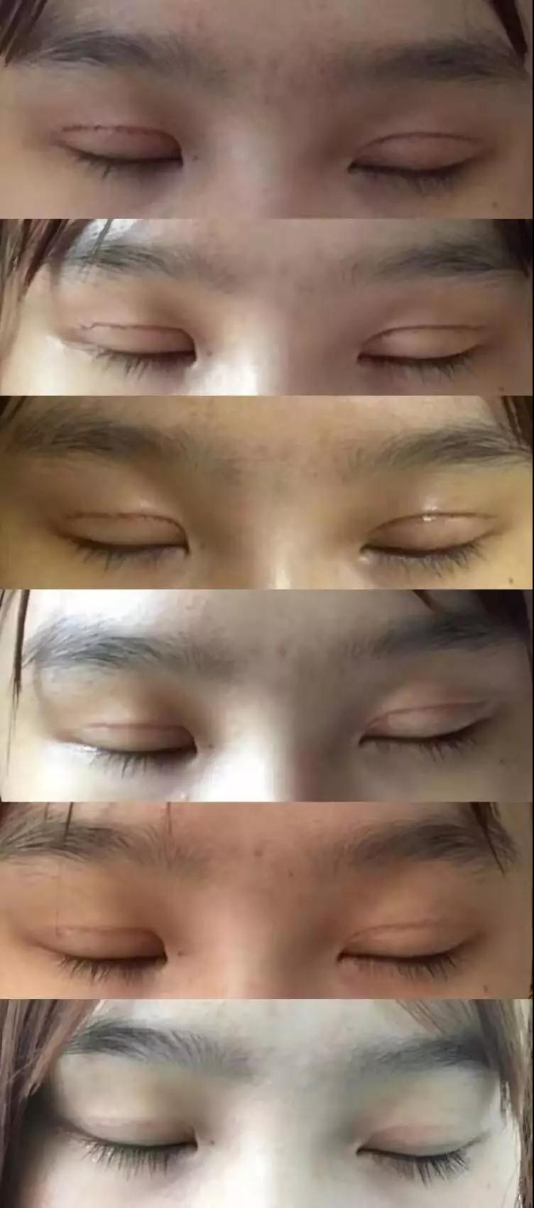 濟(jì)南坤如瑪麗崔金珍雙眼皮案例術(shù)后閉眼狀態(tài)
