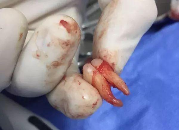 福州登特口腔拔智齒有哪些利弊？拔智齒有哪些情況？