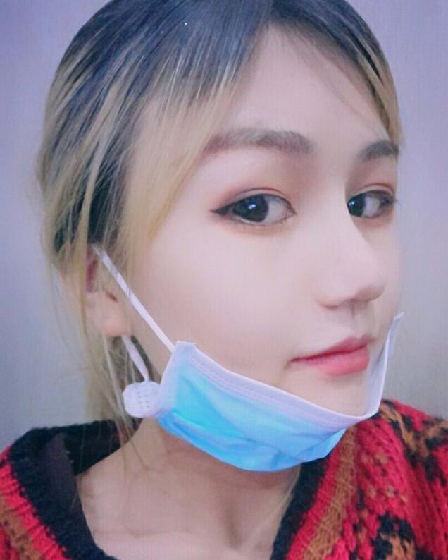 成都蜀尚蓉雅美容整形醫(yī)院做鼻綜合術后恢復好的情況