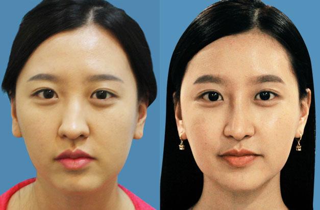 面部不對(duì)稱可以怎么矯正？臉一邊大一邊小怎么矯正？
