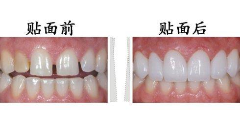 東莞拜博口腔瓷貼面有什么優(yōu)勢(shì)？瓷貼面有副作用嗎？