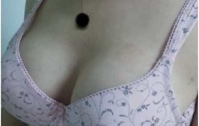 上海美萊醫(yī)療美容門診部做假體隆胸術(shù)后無(wú)鋼圈內(nèi)衣