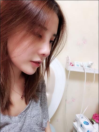 上海藝星醫(yī)療美容醫(yī)院做鼻綜合術(shù)后的日?；謴?fù)情況