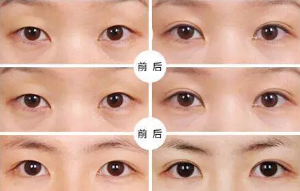 貴州旭美人整形埋線雙眼皮優(yōu)點(diǎn)有哪些如何選擇？