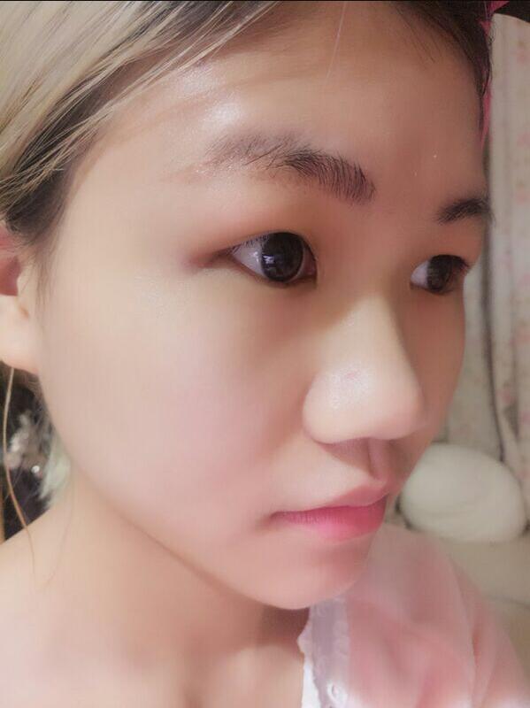 成都蜀尚蓉雅美容整形醫(yī)院做鼻綜合手術前的鼻子