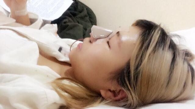 成都蜀尚蓉雅美容整形醫(yī)院做鼻綜合手術剛剛結束后的側面