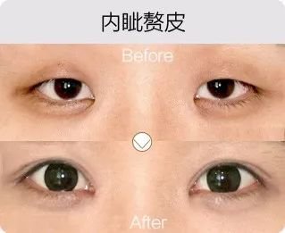 哈爾濱成美整形內(nèi)眥贅皮矯正怎么樣有哪幾種手術(shù)方法？